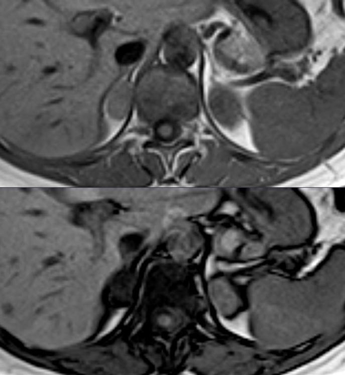 adrenal adenoma MRI