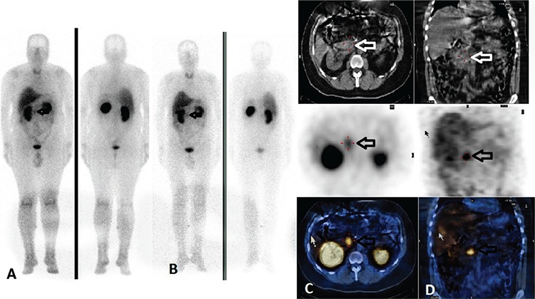 MIBG scintigraphy whole body scan