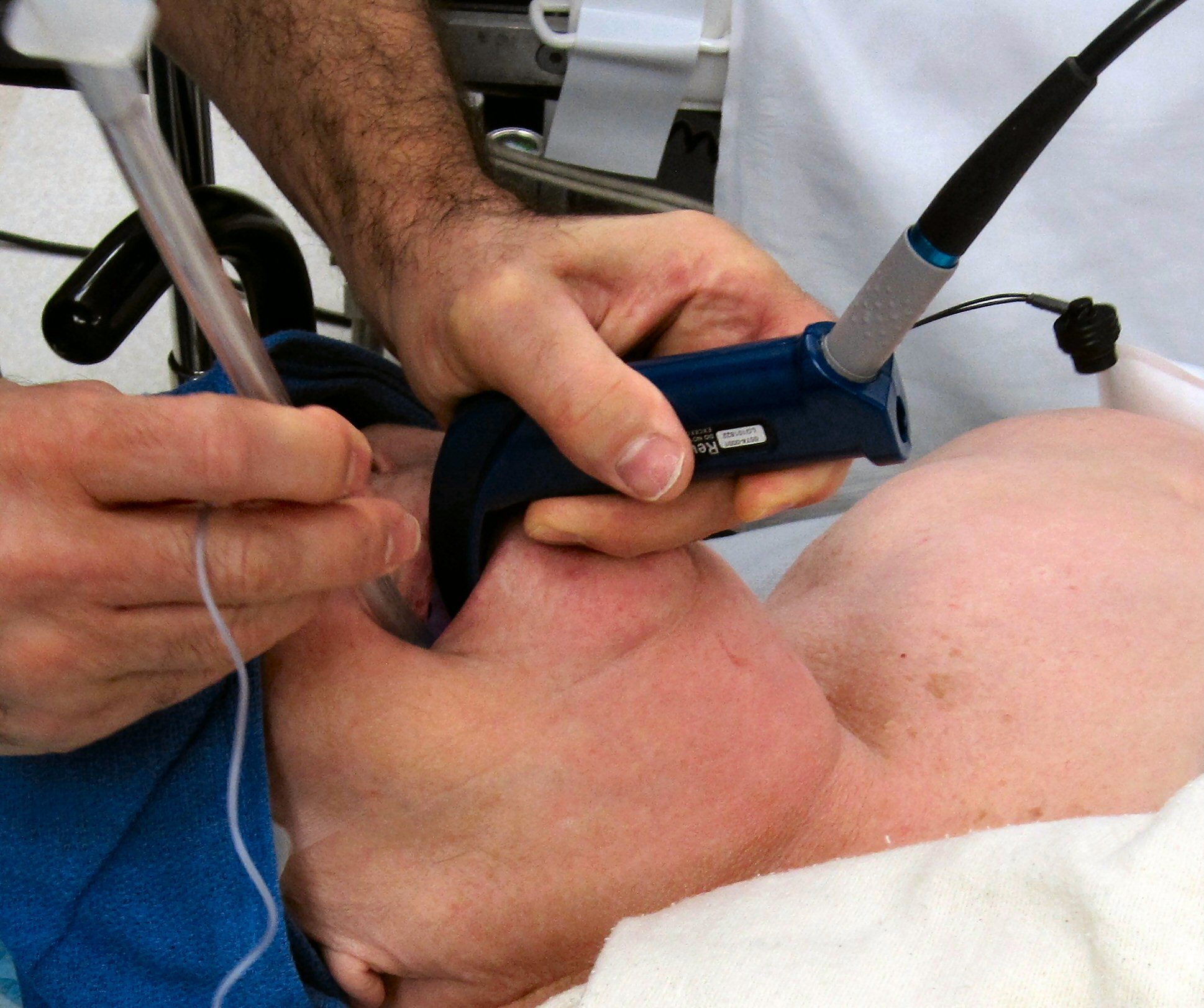 endotracheal intubation of a patient