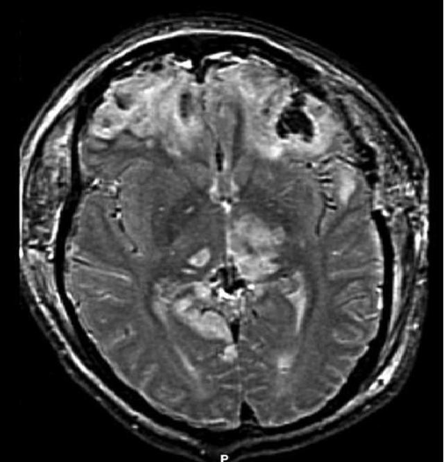 traumatic brain injury on MRI