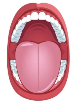 Clinical illustration of an oropharyngeal view: open mouth with the tongue maximally protruded; only the hard palate is visible — the soft palate, uvula, and faucial pillars
are completely obscured by the base of the tongue. This is Modified Mallampati Class IV.