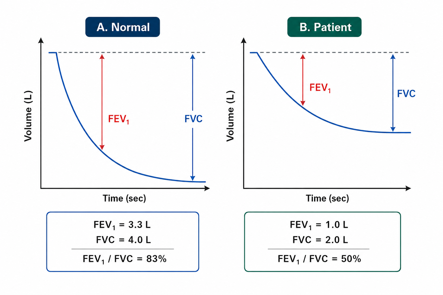 Volume-time spirometry tracing comparing a normal subject (FEV1 3.3 L, FVC 4.0 L,
FEV1/FVC 83 percent) with a patient (FEV1 1.0 L, FVC 2.0 L, FEV1/FVC 50 percent) showing a much flatter rise consistent with obstructive ventilatory defect