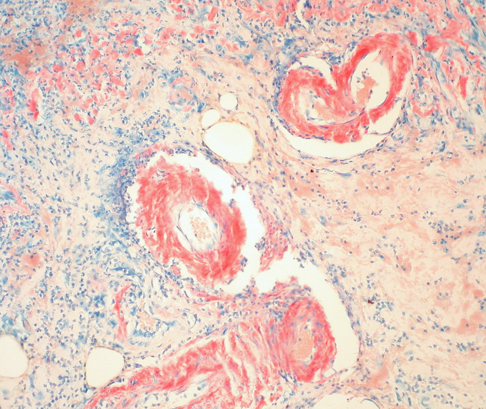 Congo red stained
  tissue showing salmon-red amyloid deposits in vessel walls on light microscopy