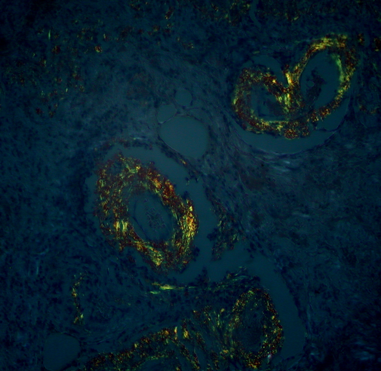 The same amyloid deposits viewed under crossed polarizers showing apple-green birefringence