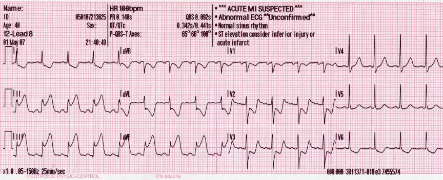 12-lead ECG with ST elevation in the inferior
  leads II, III, and aVF, machine-annotated as suspected acute inferior infarct