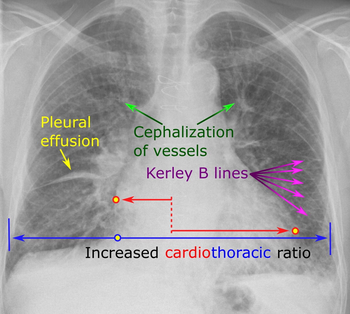 Annotated chest X-ray of congestive heart failure showing increased cardiothoracic ratio, cephalization of vessels, Kerley B lines, and a
  pleural effusion