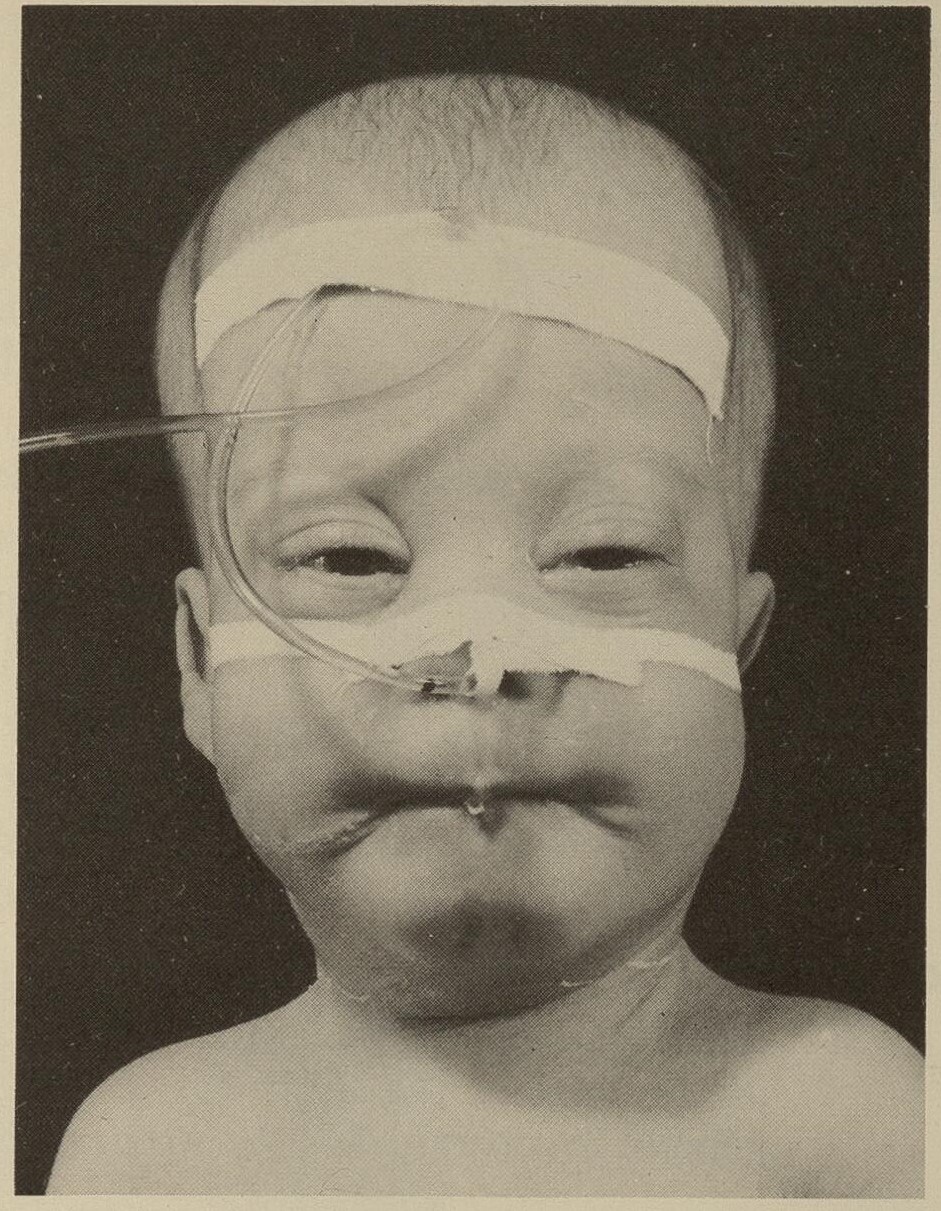 Infant with cerebro-hepato-renal Zellweger syndrome showing craniofacial dysmorphism with a high forehead and flat facial profile