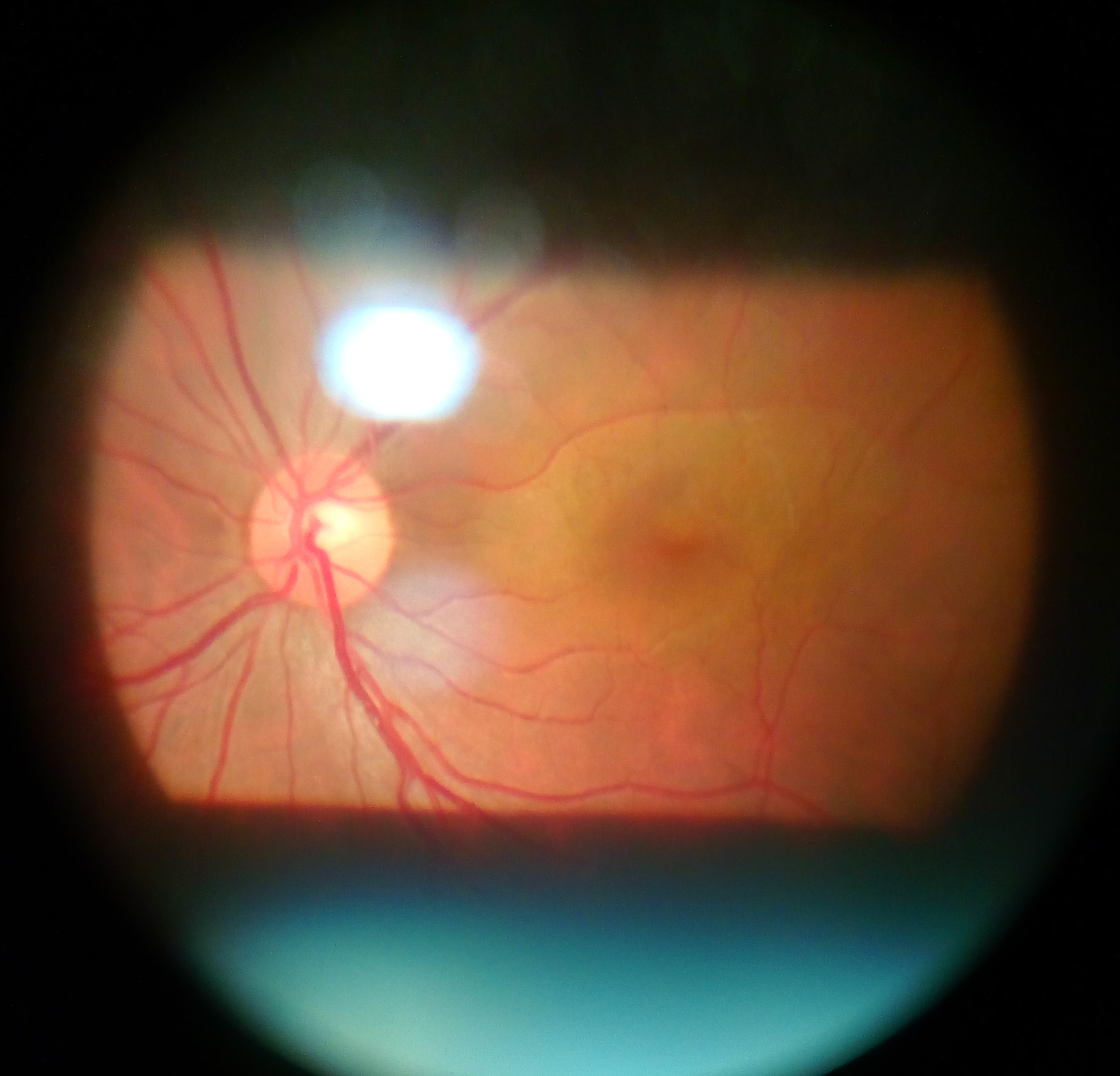 Fundus view obtained through a condensing lens at the slit lamp, showing the optic disc, macula, and retinal vessels
