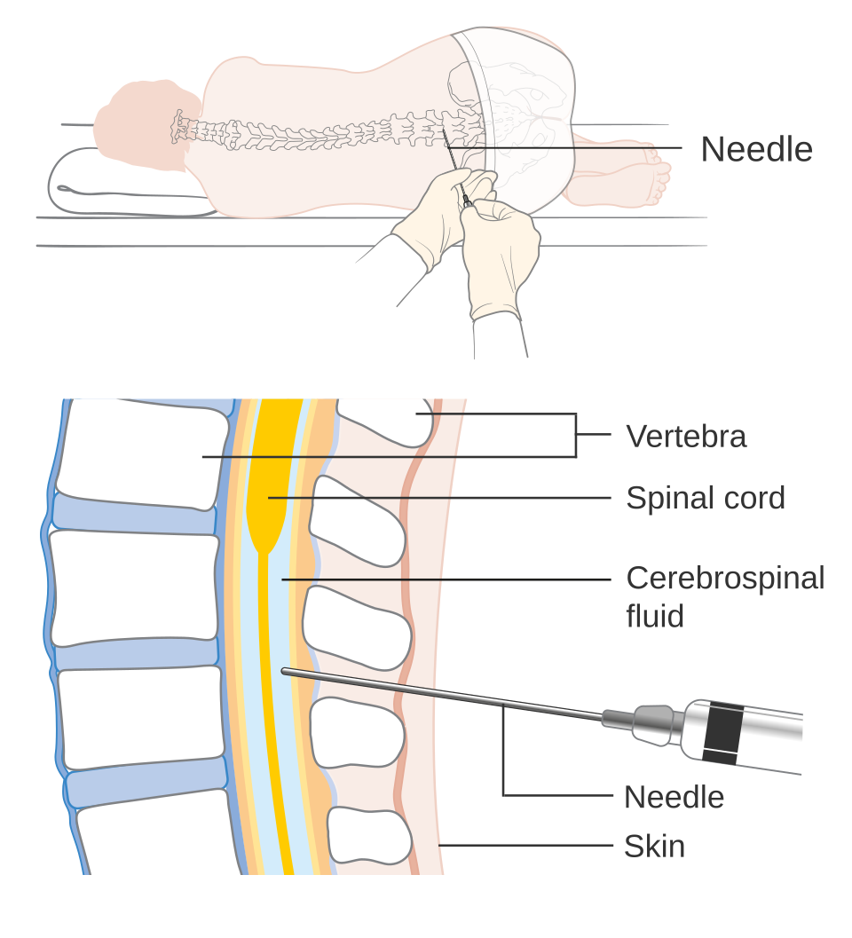 Diagram of a lumbar puncture showing the needle passing between lumbar vertebrae into the subarachnoid space to sample cerebrospinal fluid