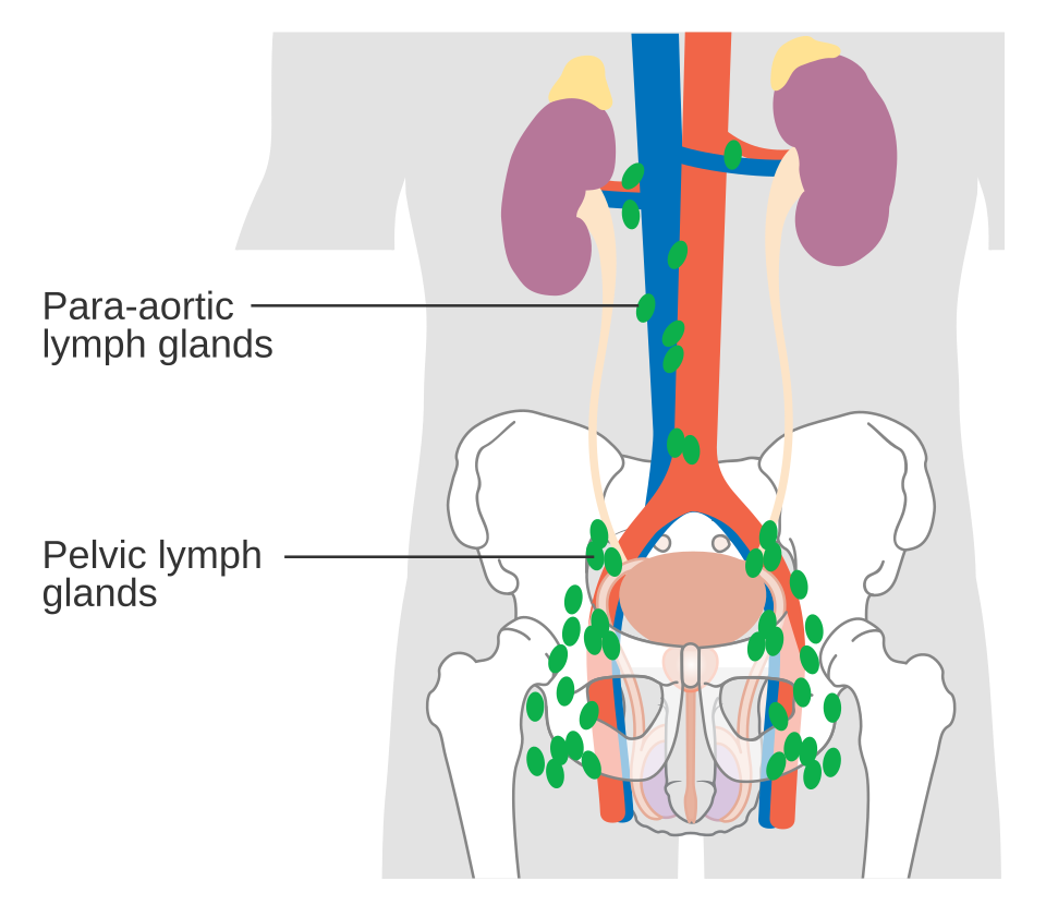 Diagram of the abdomen and pelvis labelling the para-aortic lymph glands along the aorta and the pelvic lymph glands