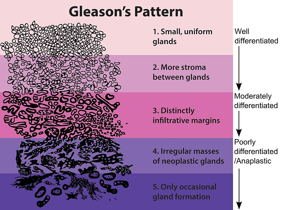 Schematic of Gleason patterns 1 to 5 showing progressive loss of glandular differentiation in prostate cancer