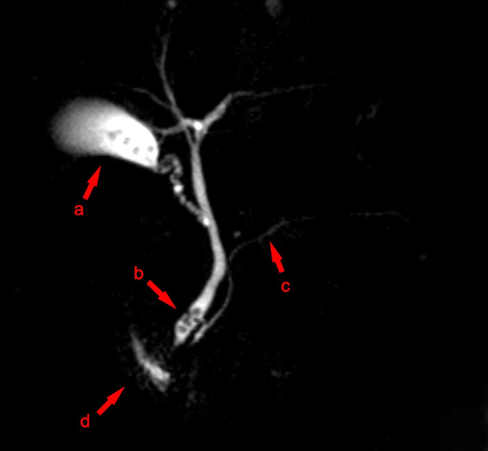 MRCP image of the biliary tree showing gallbladder and common bile duct calculi causing obstruction