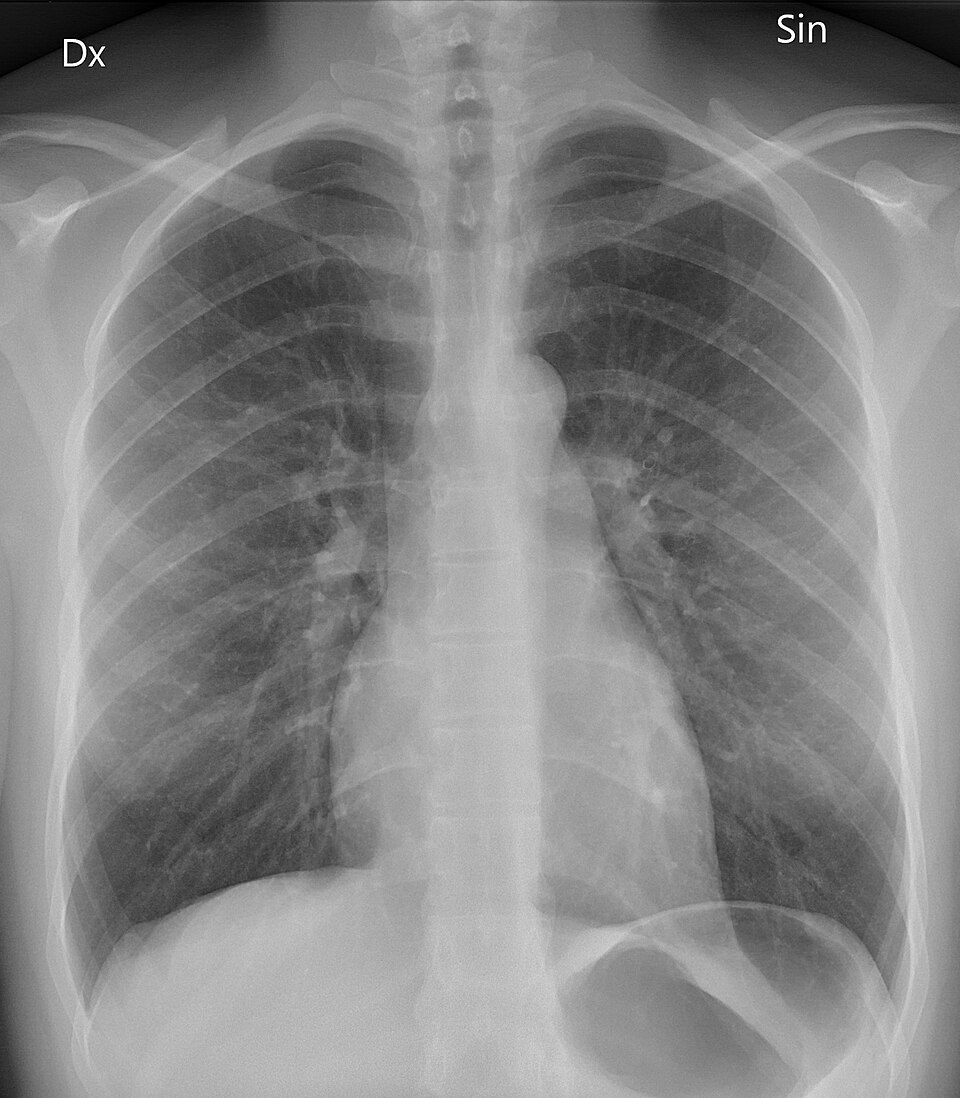 Normal posteroanterior chest radiograph with clear lung fields and a normal cardiac silhouette