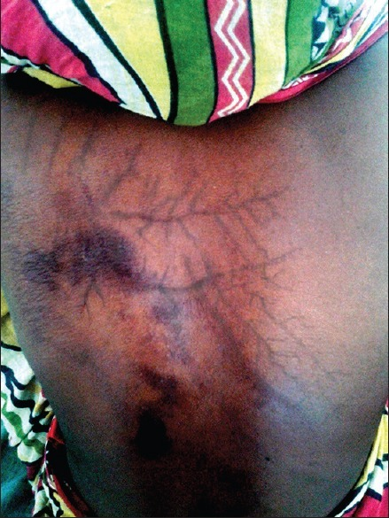 Fern-like branching Lichtenberg figure on the skin of a lightning strike victim