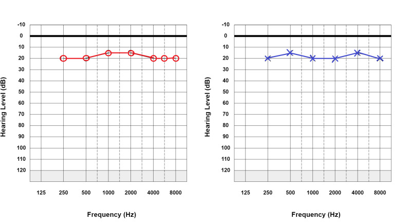 A normal audiogram showing hearing thresholds across frequencies