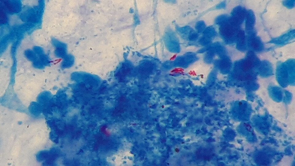 Ziehl-Neelsen stained sputum smear showing red acid-fast bacilli of Mycobacterium tuberculosis