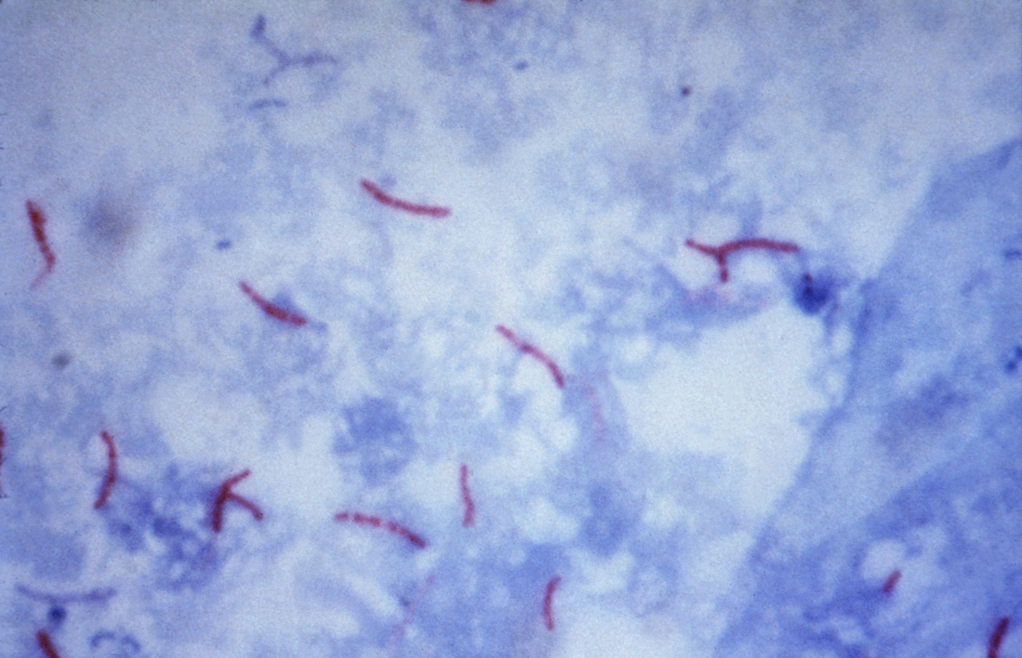Ziehl-Neelsen stained sputum smear showing red curved
  acid-fast bacilli of Mycobacterium tuberculosis against a blue background