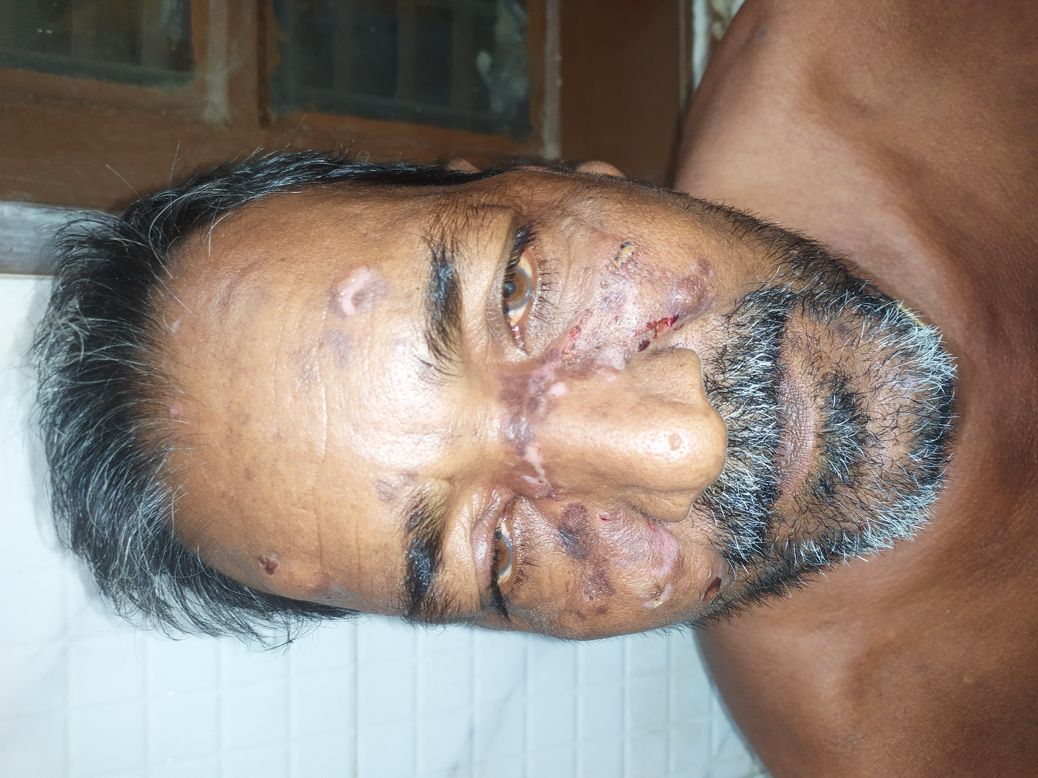 Clinical photo of pemphigus vulgaris with crusted erosions over the face