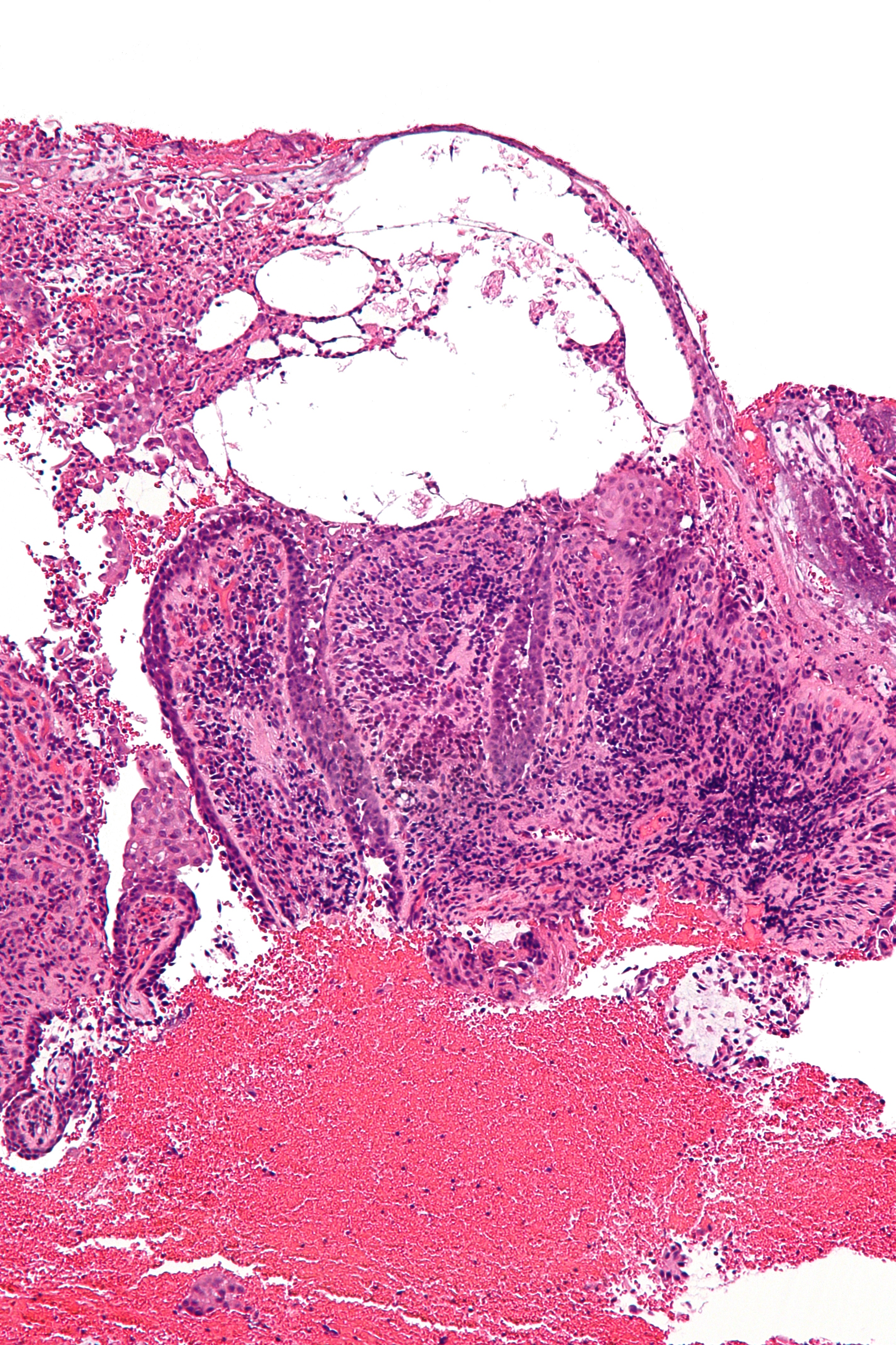 H&E histology of pemphigus vulgaris showing a suprabasal blister with
  acantholysis and a tombstone row of basal cells