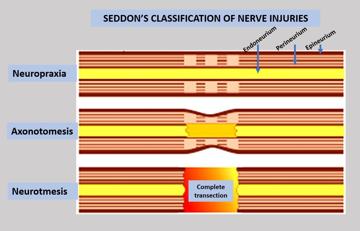 Diagram of Seddon's classification: neurapraxia (focal
  demyelination, axon intact), axonotmesis (axon disrupted, sheaths intact), neurotmesis (complete transection)