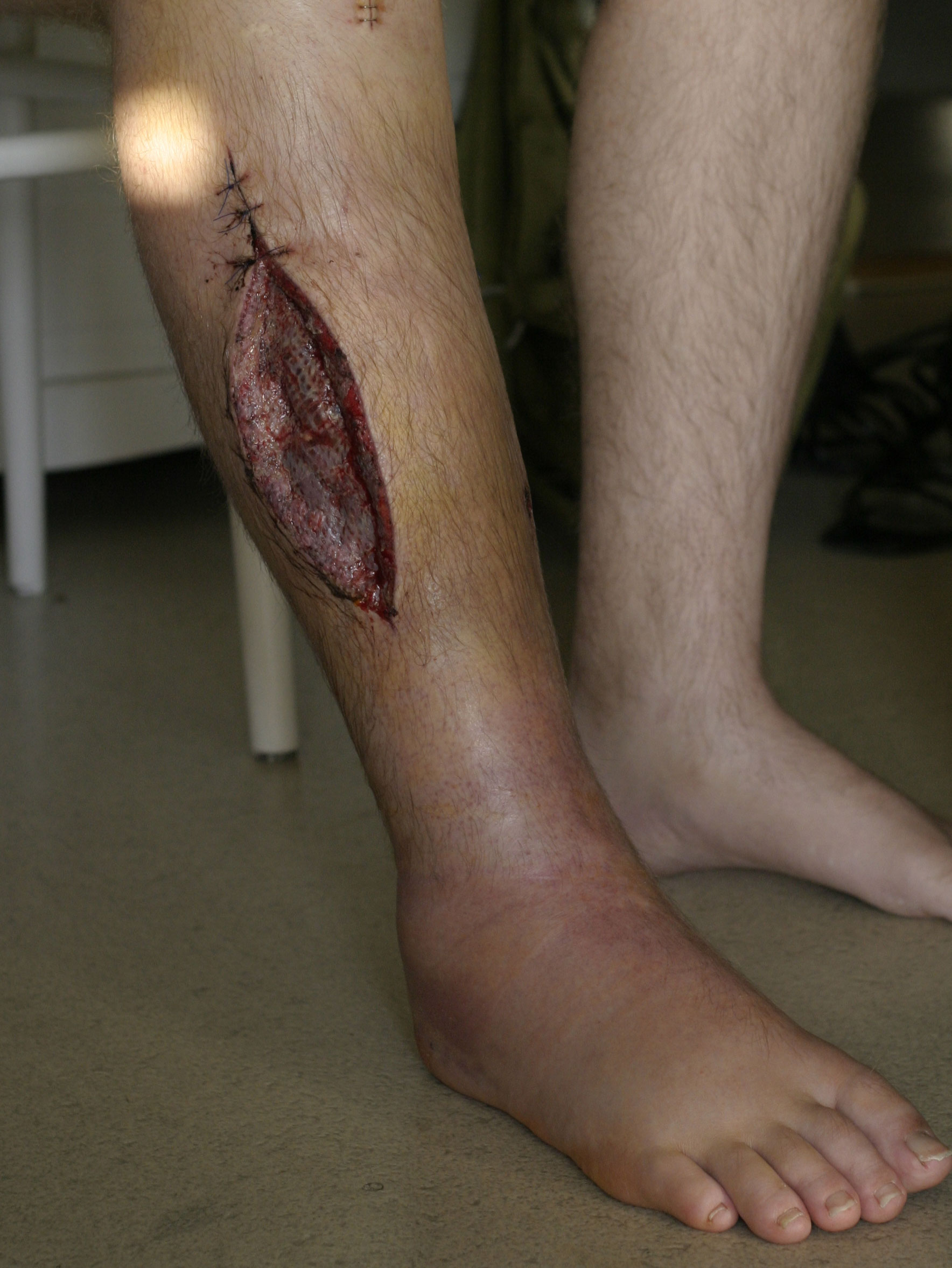 Lower leg after fasciotomy showing a long open decompression incision with a skin graft over
  the muscle