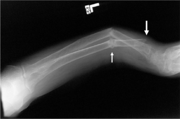 Forearm radiograph in severe osteomalacia showing bone softening with bowing and a pseudofracture (Looser zone)