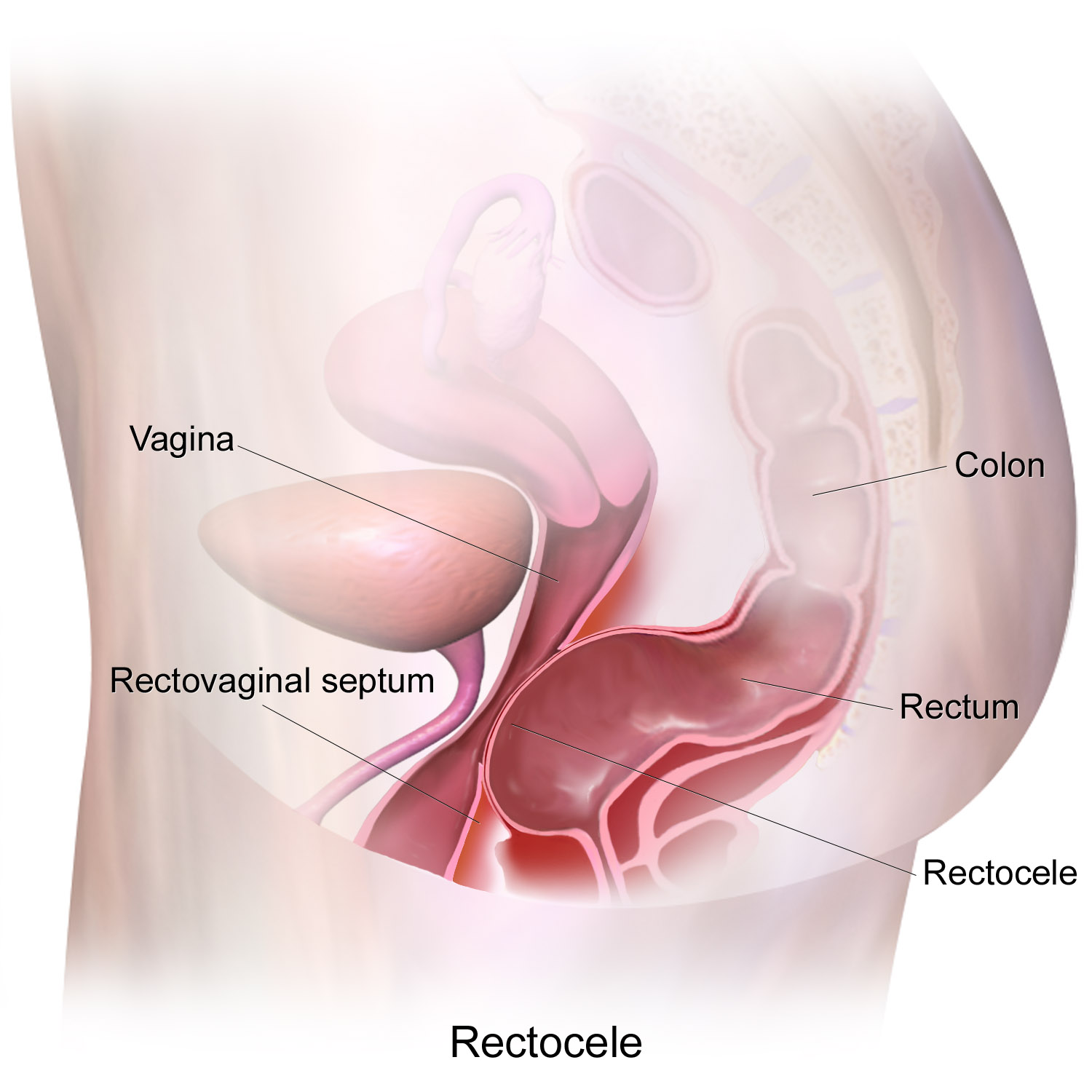 Sagittal diagram of a rectocele showing the rectum bulging anteriorly through the
  rectovaginal septum into the vagina