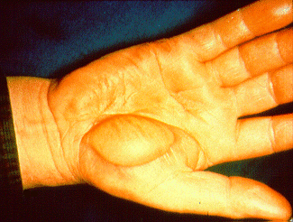 Electrical contact burn on the palm