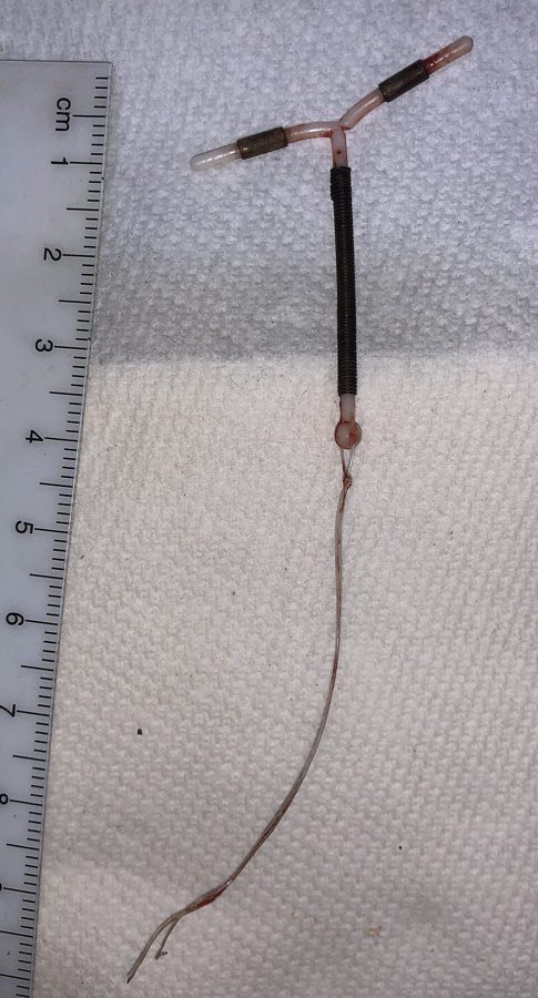 Copper T (IUCD)
