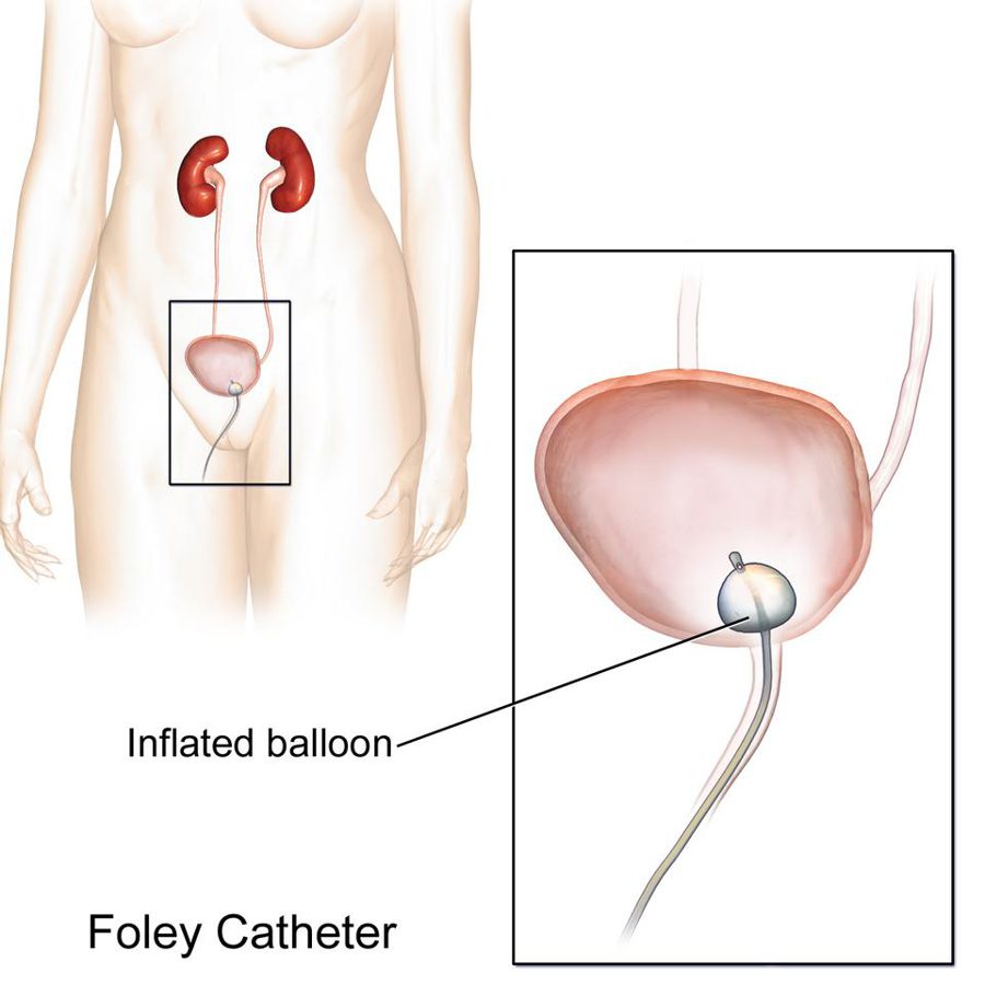 Foley catheter