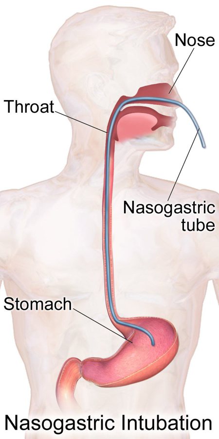Ryle's tube (nasogastric tube)